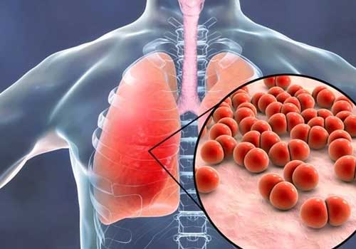 Pneumonia / Respiratory Infections