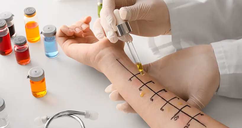 Allergy Testing