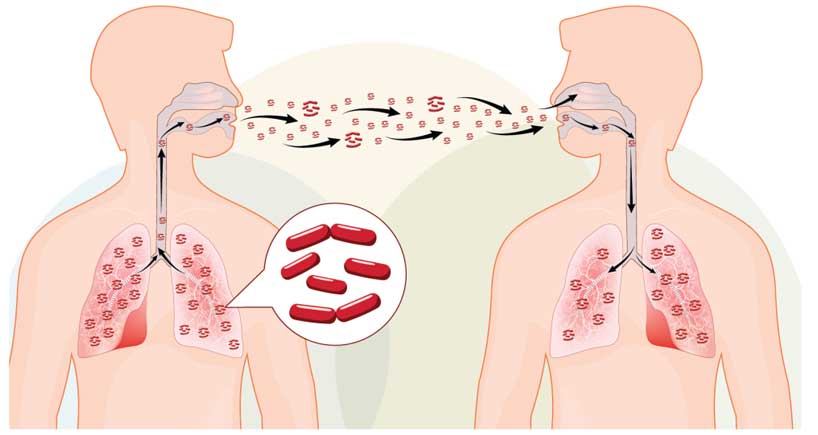 Bronchiectasis